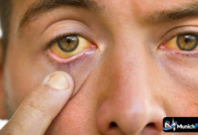 Leicht gelbe Augen am Rand