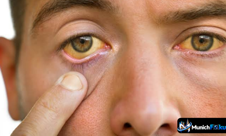 Leicht gelbe Augen am Rand